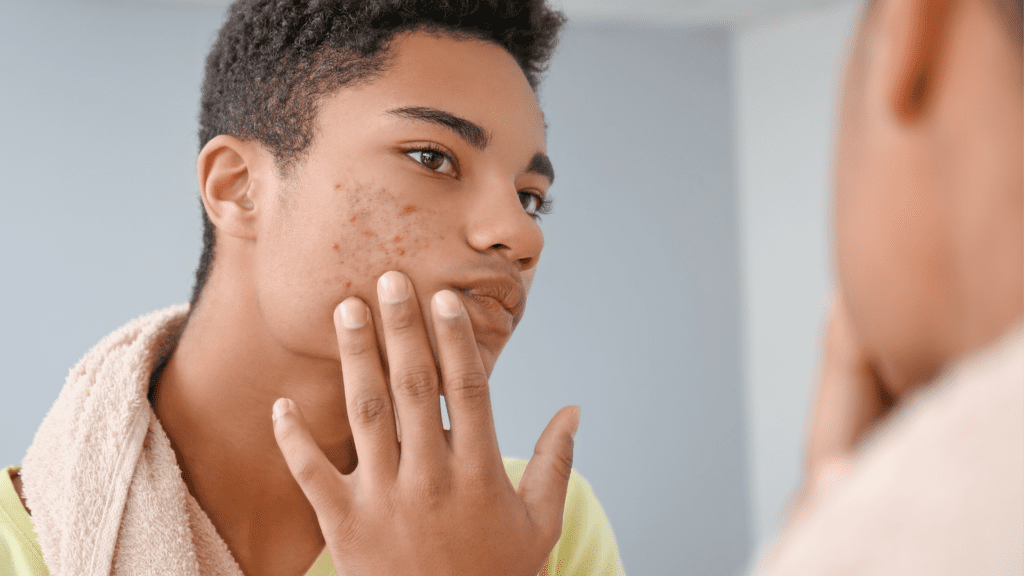 Close-up of clear, healthy skin after acne treatment using Forever Clear BBL at Encompass Wellness & Aesthetics